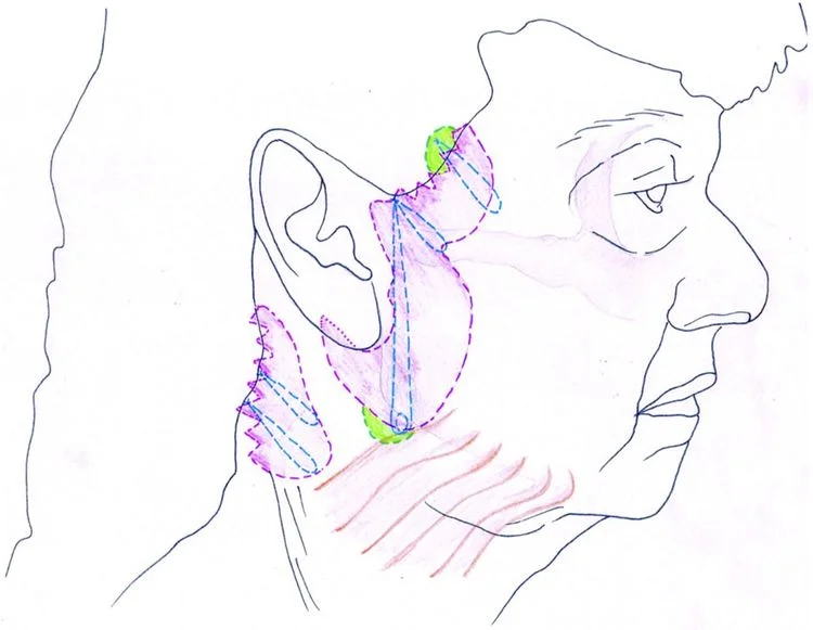 Figure 2. - This illustration highlights the main areas addressed in the posterior cervicoplasty technique. “U” suture: MACS-like SMAS plication from temporal fascia above zygomatic arch, includes posterior edge of platysma. “O” suture: dermis and subcutaneous tissue, including SMAS to temporal fascia above the zygomatic arch. Third suture: dermis and subcutaneous tissues to temporal fascia above zygomatic arch. Posterior cervicoplasty sutures skin and subcutaneous approximation sutures using 3.0 PDS. Further 3-0 PDS skin approximation sutures from the deep dermal layer to the pre-auricular epichondrium (purple shaded area, skin excision; green shaded area, two small areas skin of undermining to facilitate suture placement).