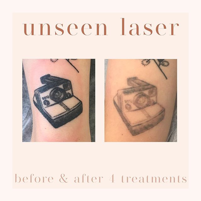 Before and after one treatment. To learn more about tattoo removal and how Unseen Laser can help you lighten or remove an unwanted tattoo, get in touch today! ⚡️Professional advice ⚡️Comfortable environment ⚡️Fast results ⚡️Best price guaranteed 📞04