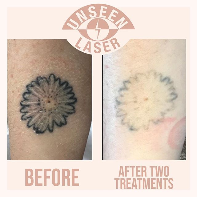 Before and after 2 treatments.  To learn more about how Unseen Laser can help you lighten or remove an unwanted tattoo get in touch today. ⚡️Professional advice ⚡️Comfortable environment ⚡️Fast results ⚡️Best price guaranteed 📞0423833684
🖥www.unsee