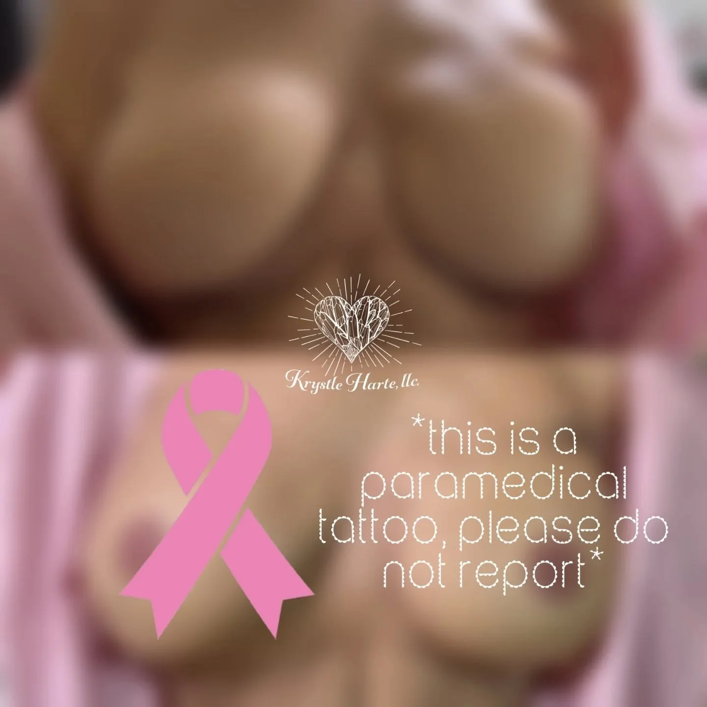 My 2nd sweet Client for Post Mastectomy 3D Areola tattooing. Her skin was a little more fragile from radiation &amp; a DIEP flap, so we wrapped up her first session here and will add a bit more dimension on the followup in 2 months time. 

#postmaste