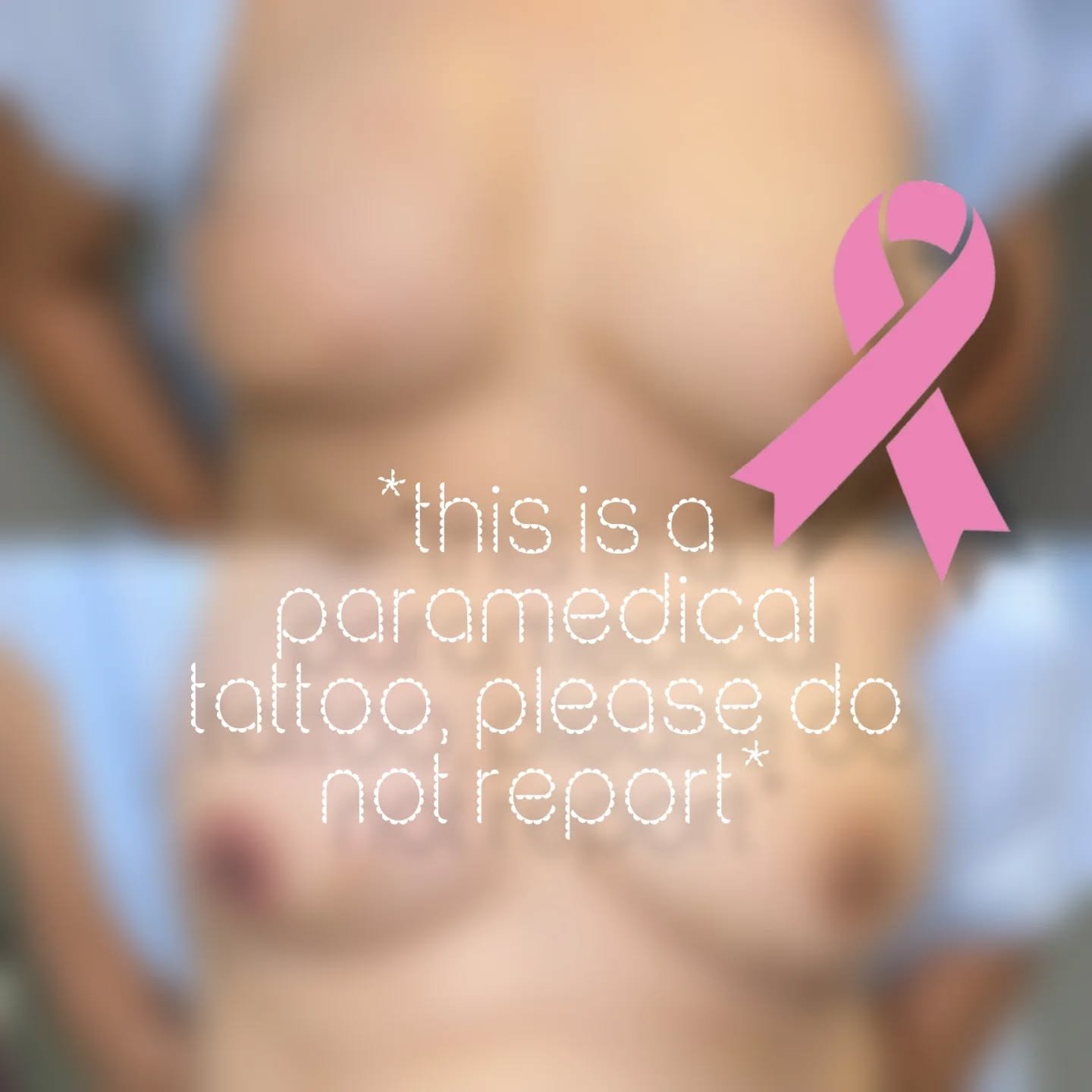 The nipple and areola are the natural focal point of the breast. When this detail is missing&mdash;especially after breast reconstruction&mdash;the eye often focuses on the scars instead. I believe recovery should bring a return to normalcy and confi