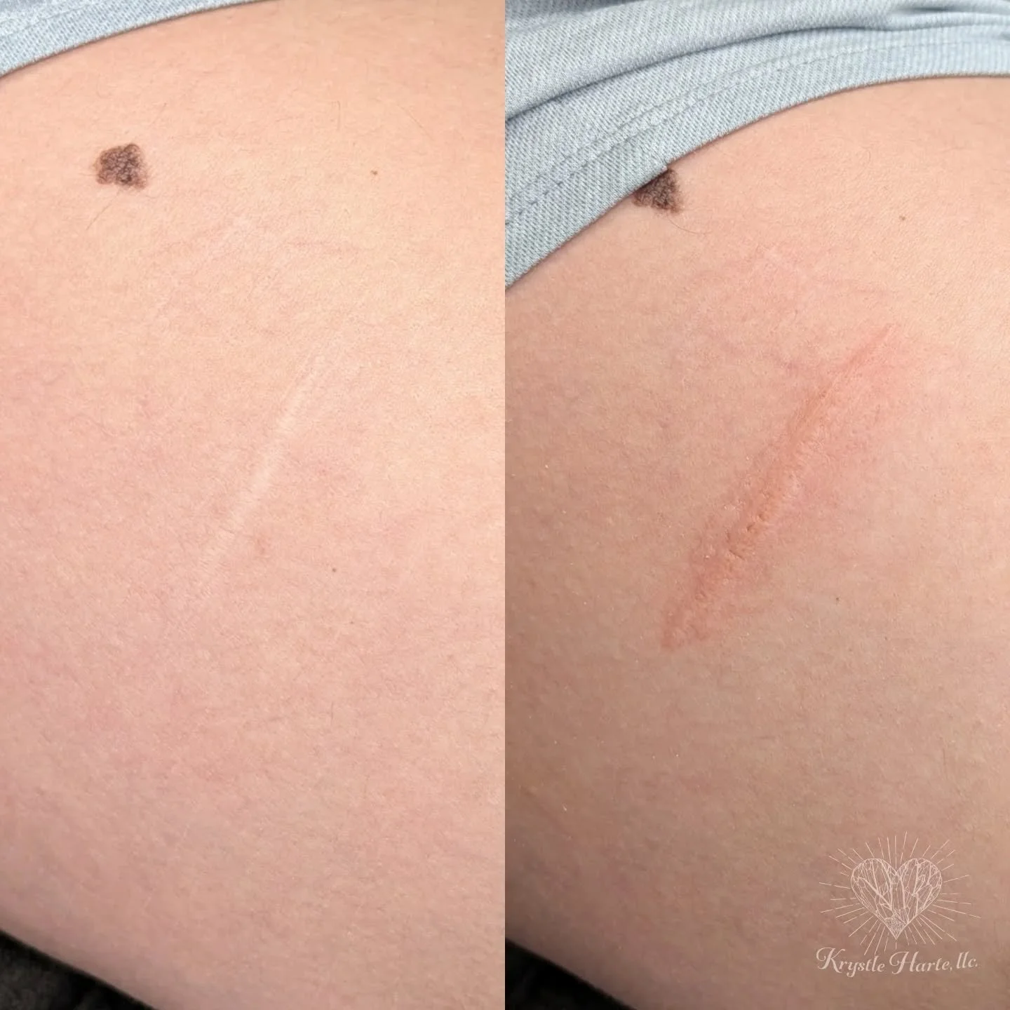 Started working with this sweet client on some scarring camouflage. It may take a few session, but along with softening the scar tissue we are also adding subtle color precisely to match her skin tone! 

Check back in a few weeks to see her healed re