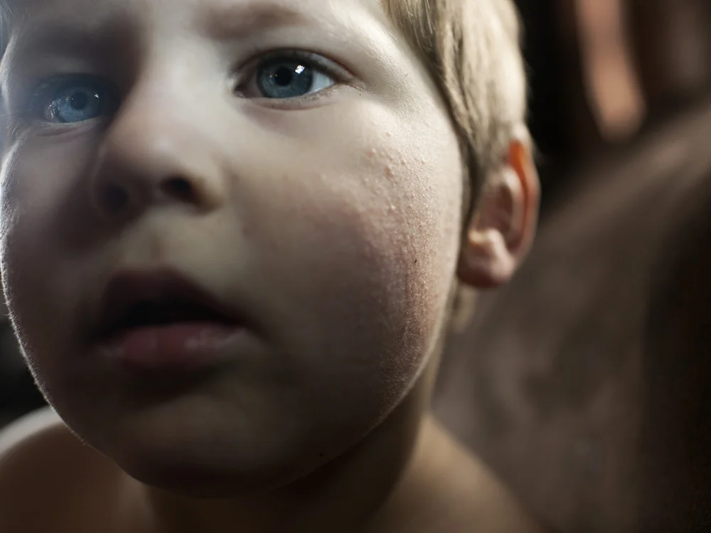 Tamara Horn's son, Aidan, showing the rashes on his face that his parents say are a result of drinking and using contaminated water. The family and several others on Carter Road in Dimock claim that they had their well water contaminated, allegedly by nearby gas-drilling activities of Cabot Oil and Gas. Dimock, Susquehanna County, 2012. © Nina Berman/MSDP 2012