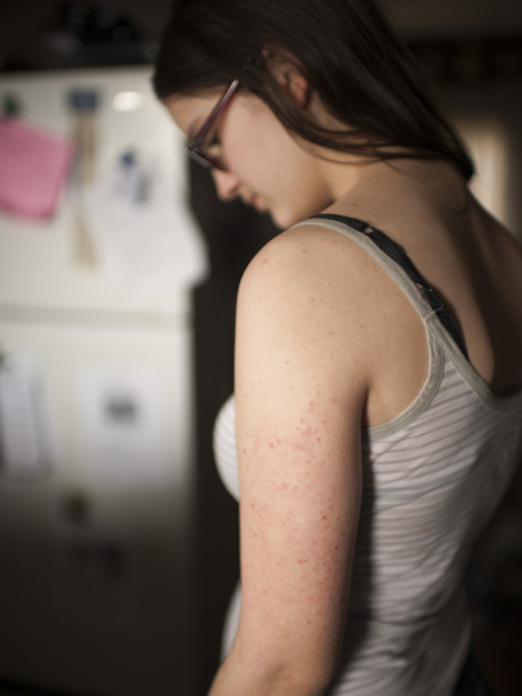  Pat Farnelli's daughterLaAnna showers in contaminated water and has rashes on her arms.&nbsp; The family's well water was contaminated following Cabot gas drilling and fracking.&nbsp; ©&nbsp;Nina Berman/MSDP 2012 