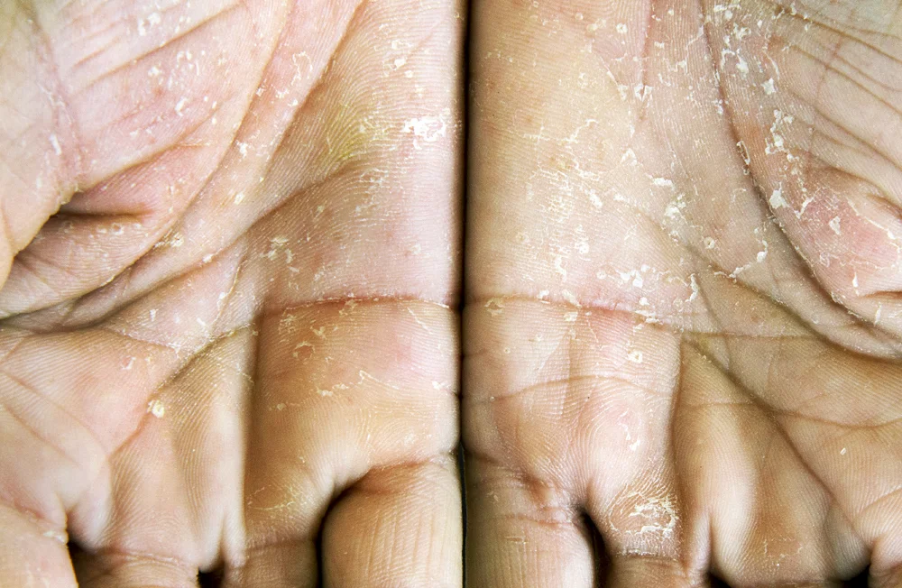 Jeannie Moten shows her hands. She thinks the scaling skin comes from washing dishes and plans to use gloves from now on. She didn't have this problem before fracking. Moten also lost her portable water from contamination and members of her family have had respiratory problems and nosebleeds that she and others feel is the result of fracking near her property. © Scott Goldsmith/MSDP 2012