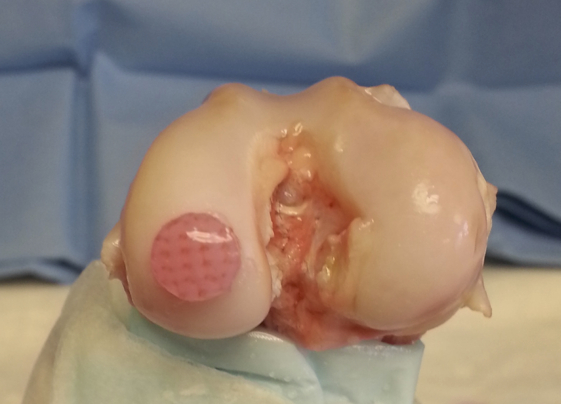  Contoured Osteochondral Constructs Fitted into Canine Knee Joint 