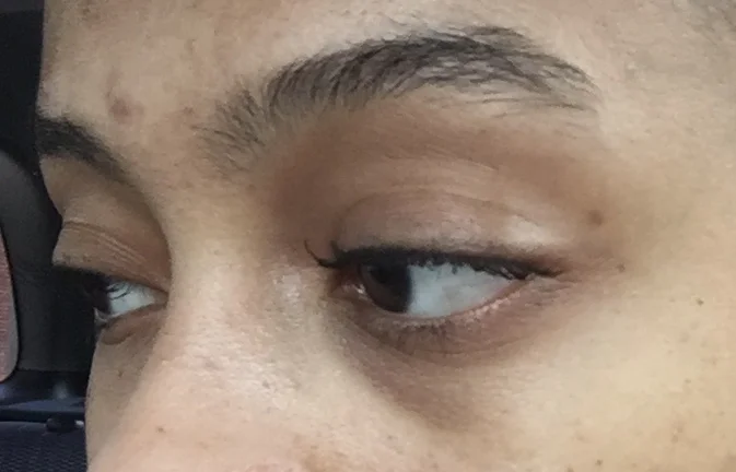 My intern year, before using eye creams, no make up.