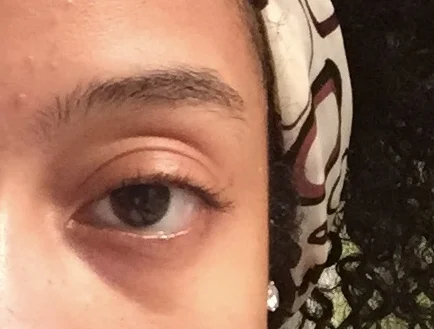 My intern year, before using eye creams, no make up.