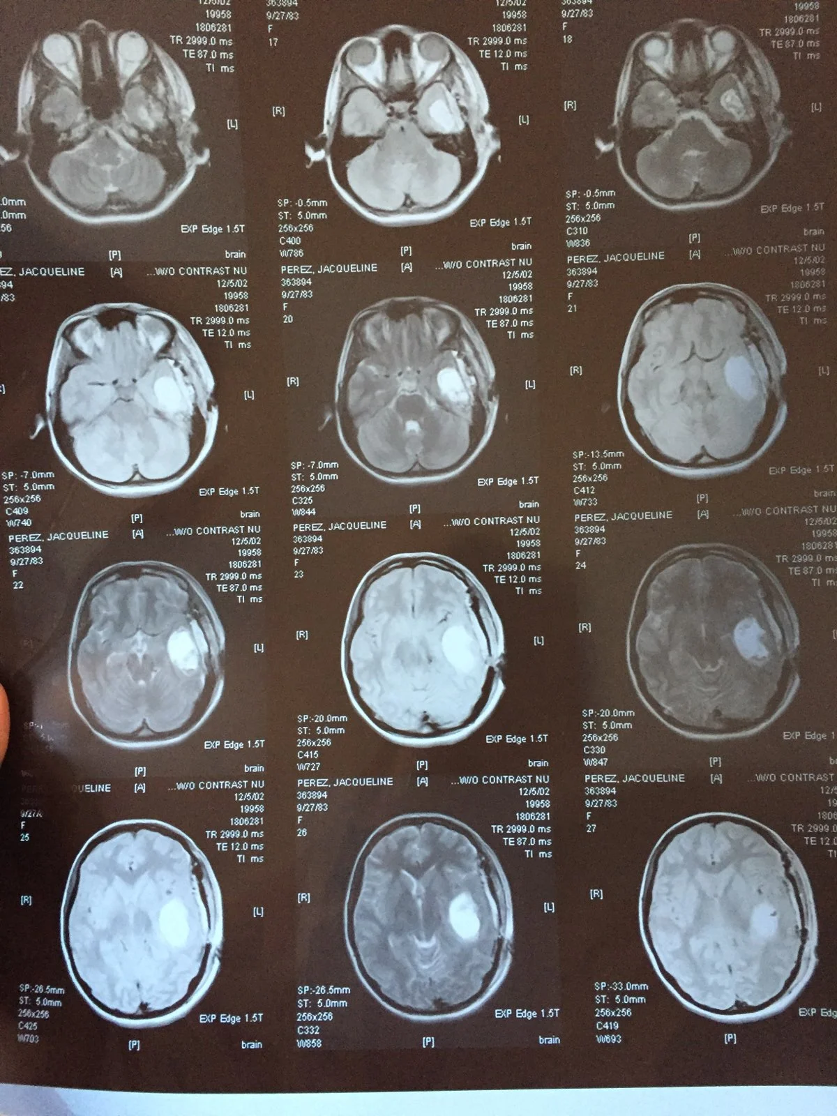 -This is post-surgery and the 20% of the tumor that remains