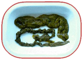 For the courageous: Hover over the image to remove the ripples and reveal some colonic results. If you want more detail, click on the image itself.