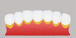 Tooth plaque and detox