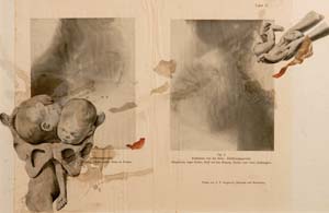 8 Survival, Decay and Excavation: curating Arthur McIntyre: DANIEL MUDIE CUNNINGHAM Arthur McIntyre, Birth Pains II, c. 1975, collage on paper. Courtesy the estate of Arthur McIntyre