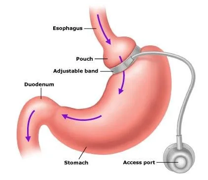 The virtual gastric band hypnotherapy protocol for Adelaide residents to lose weight fast.