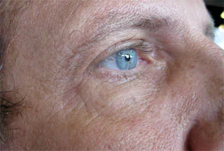 AFTER-1-PURIGENEX-MASK-FOR-.jpg