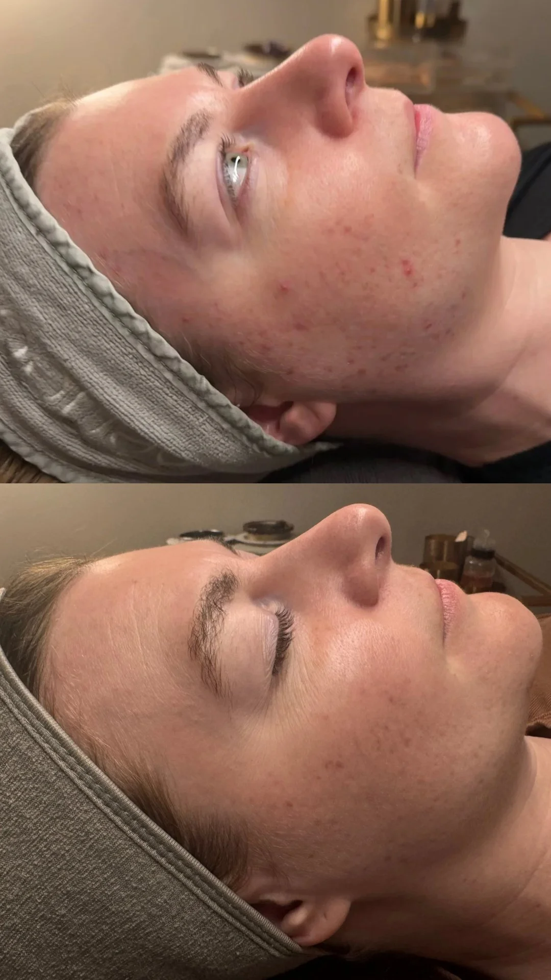 Face-Reality-Acne-Bootcamp-Results-Aurora.PNG