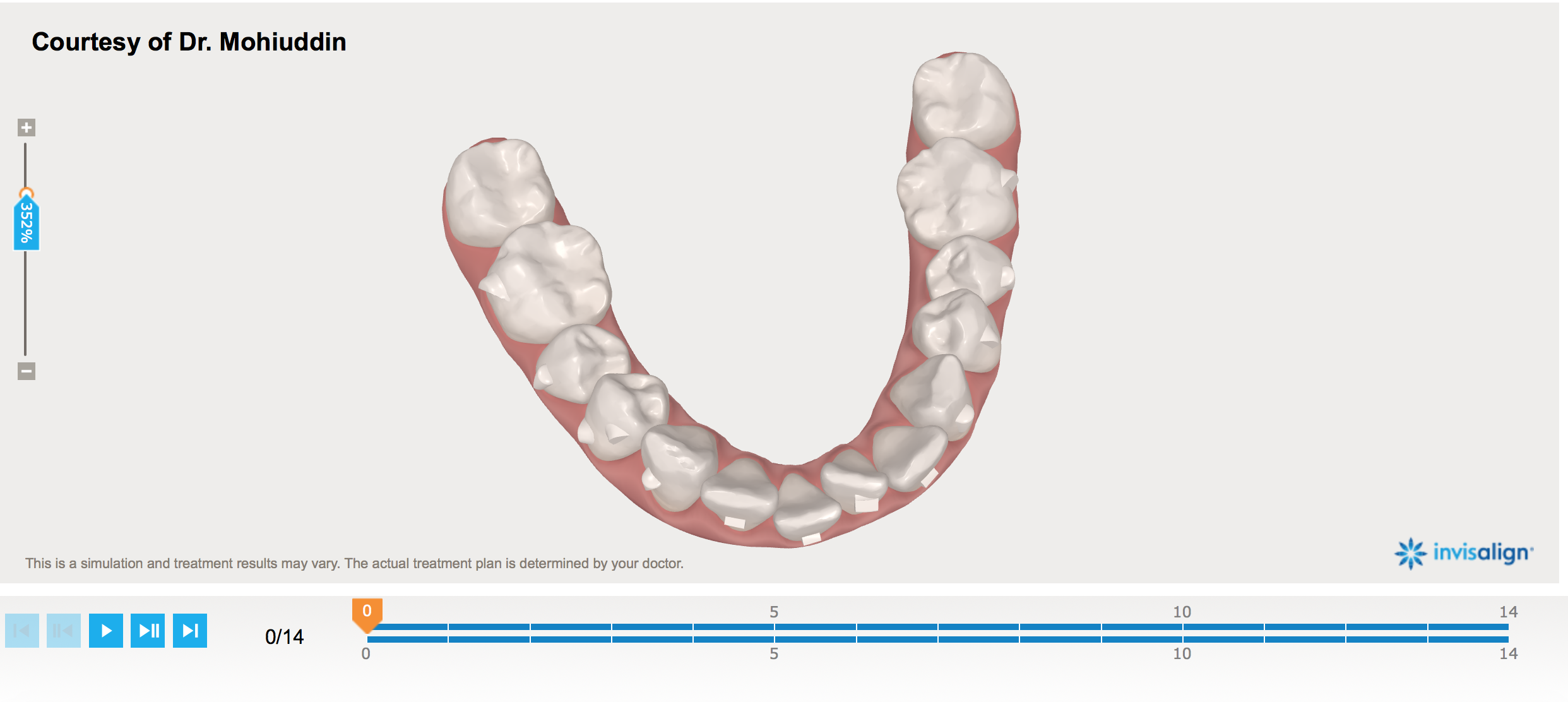 3D Scan before Invisalign and attachments