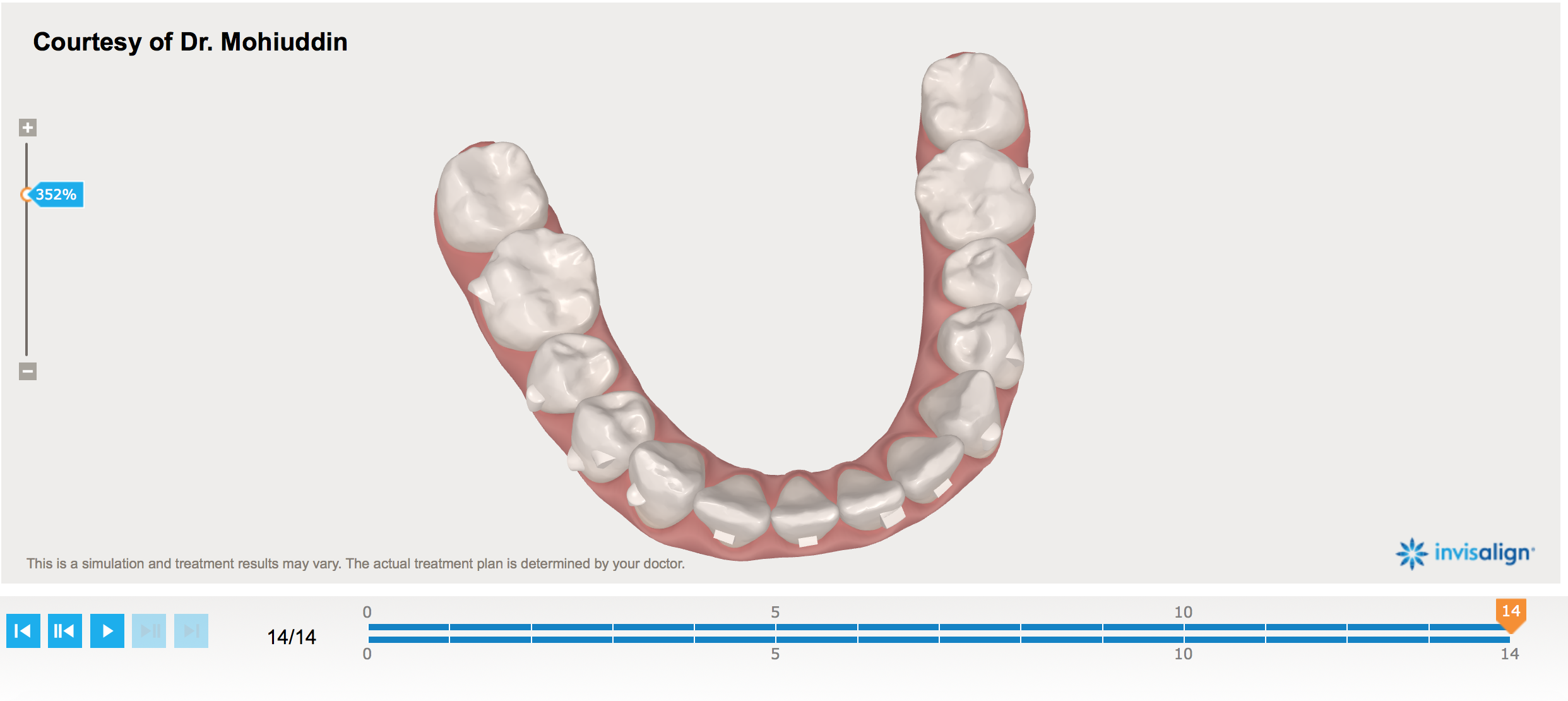 3D Scan after 14 weeks with attachments