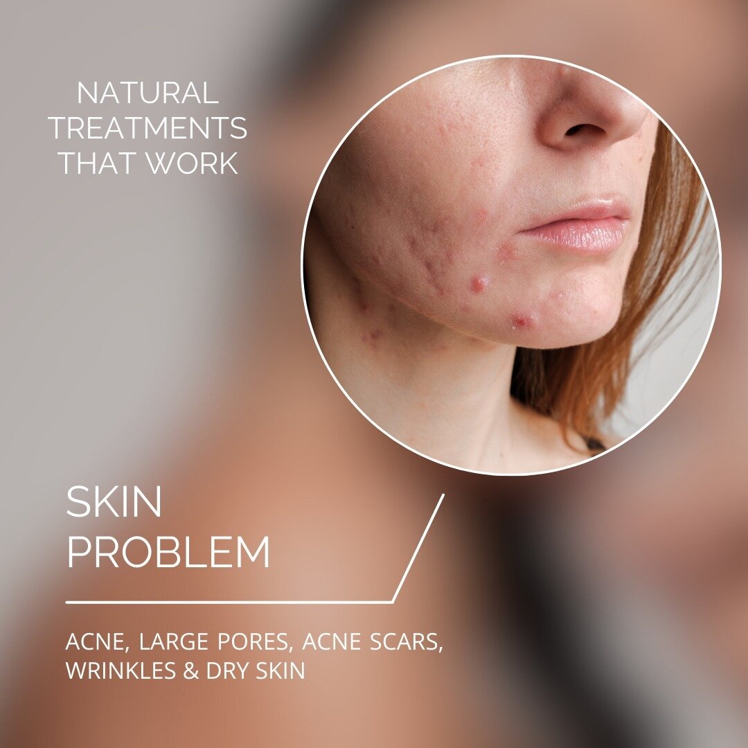 Come visit us and see what our Anti-Acne Treatments can do for you!

#AcneGone #NoAcne #SmoothSkin #LoveYourSkin