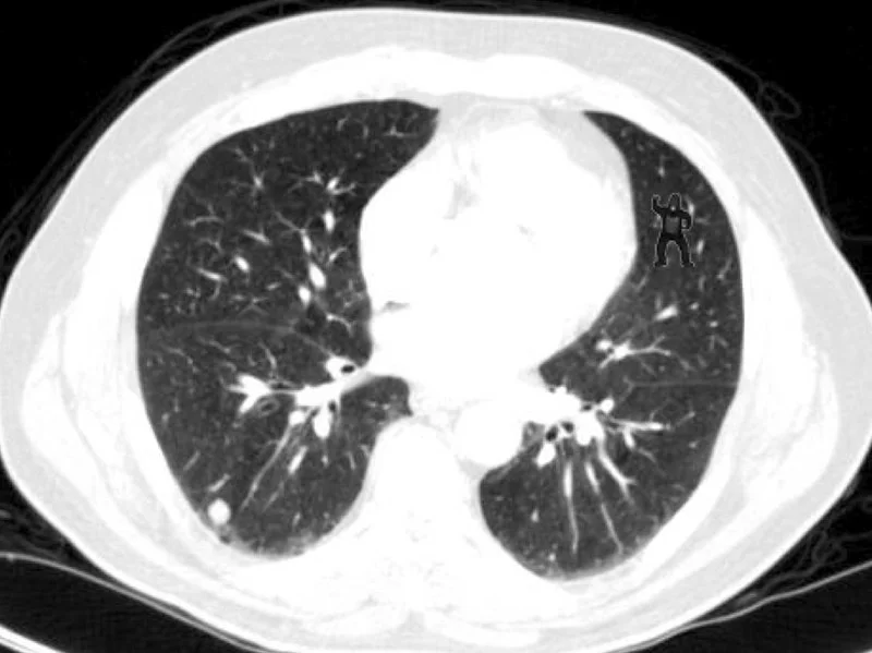 Can you find the gorilla on this brain scan? 83% of researchers missed it. Trafton Drew and Jeremy Wolfe