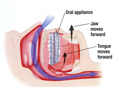 The diagram above illustrates how an oral appliance when worn during sleep opens the airway by positioning the jaw forward.