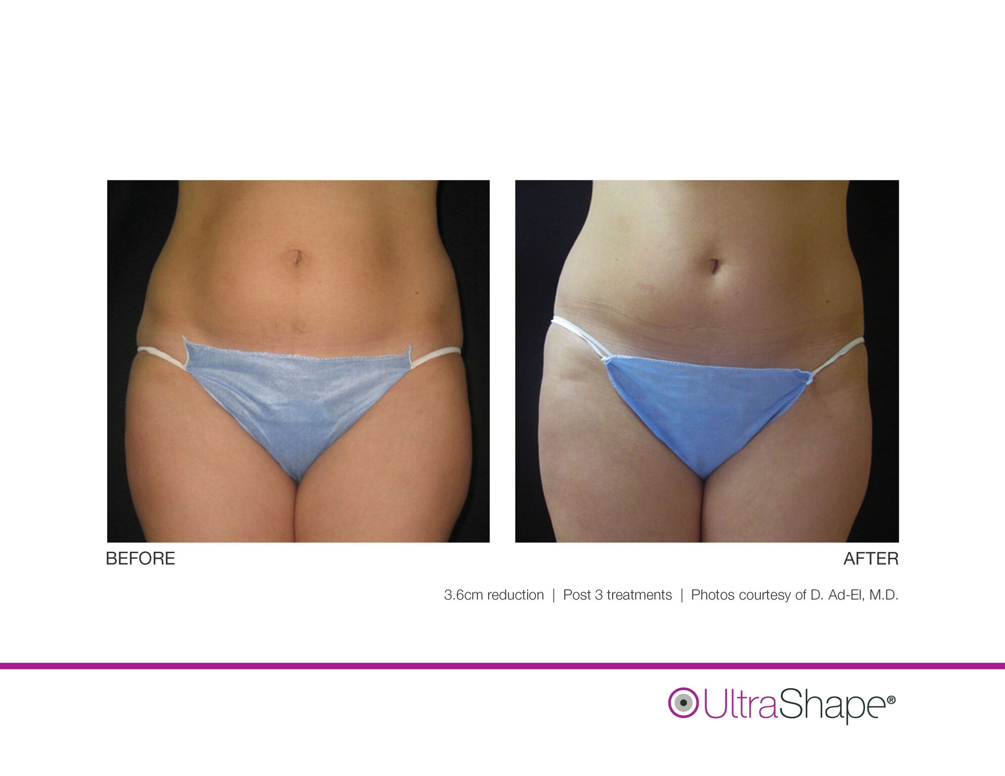 UltraShape_B_and_A_image-0_sidebyside.jpeg