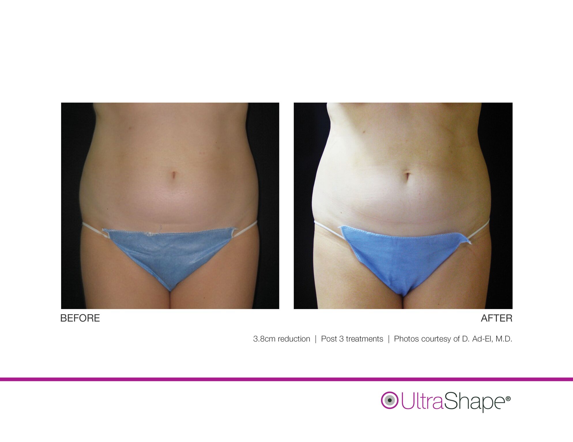UltraShape_B_and_A_image-1_sidebyside.jpeg