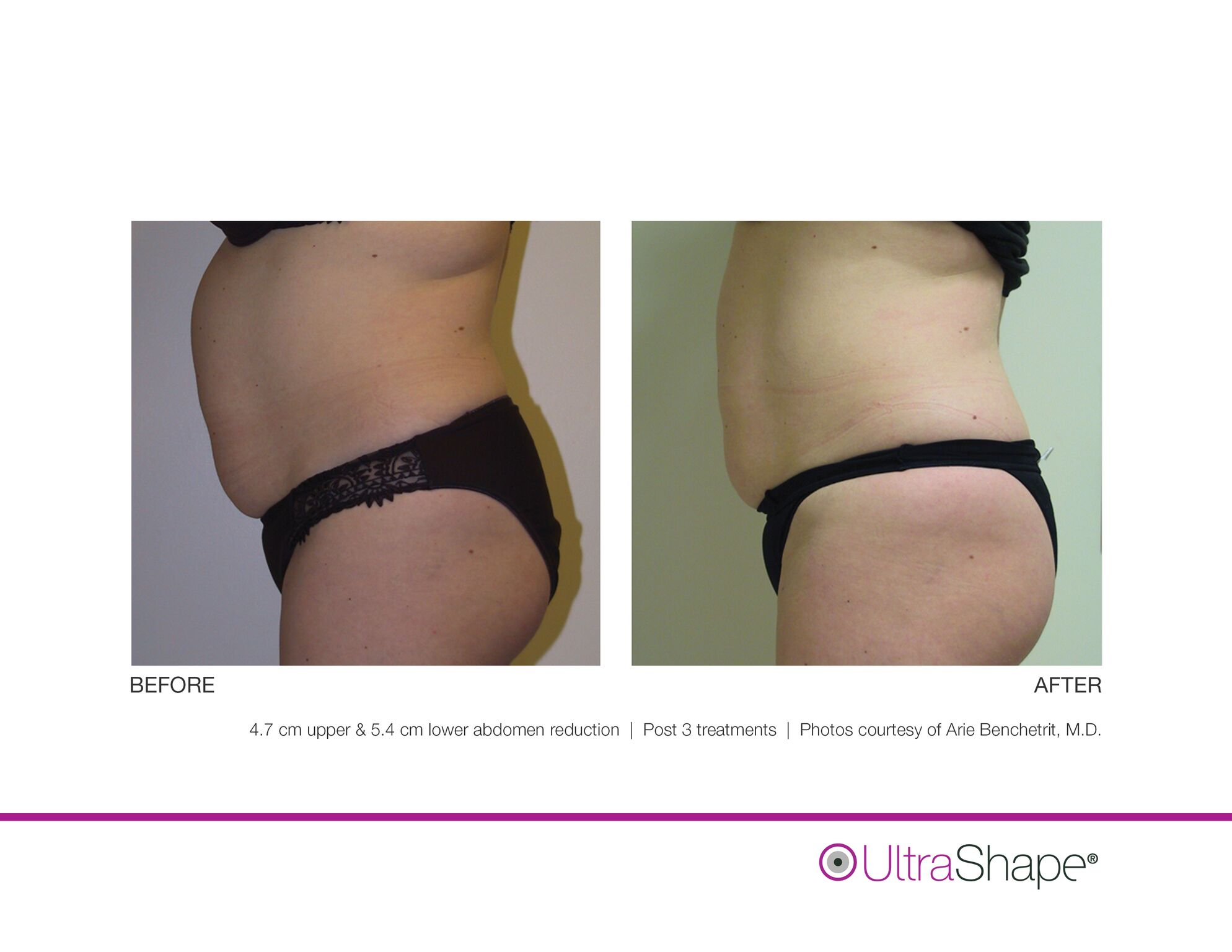 UltraShape_B_and_A_image-5_sidebyside.jpeg