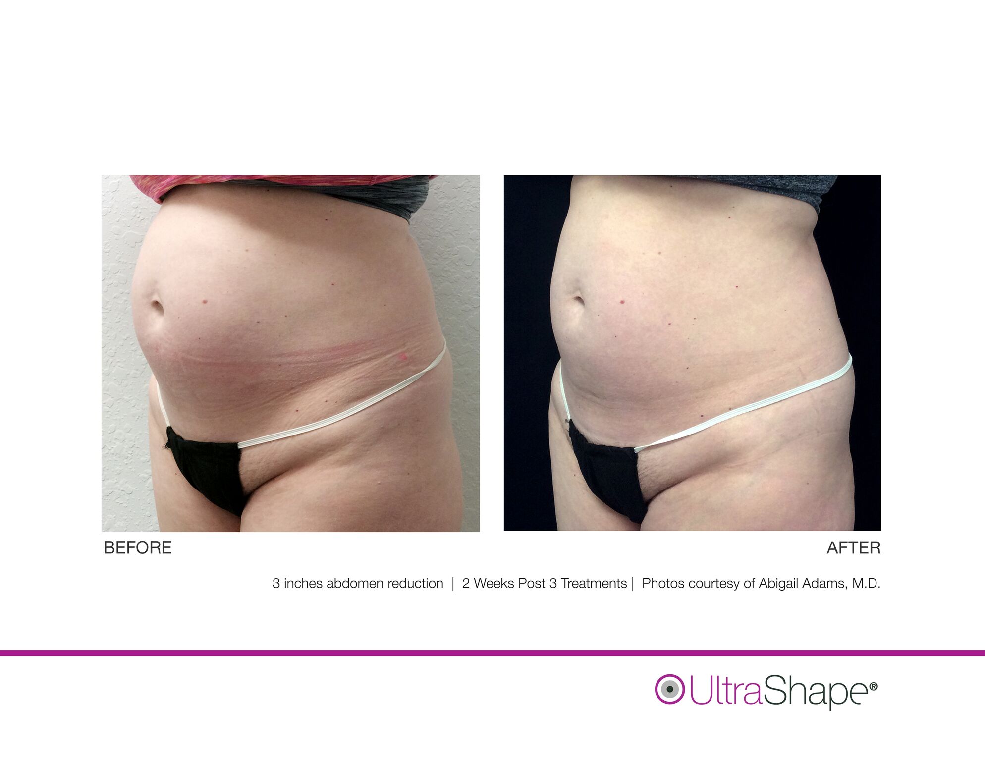 UltraShape_B_and_A_image-4_sidebyside.jpeg