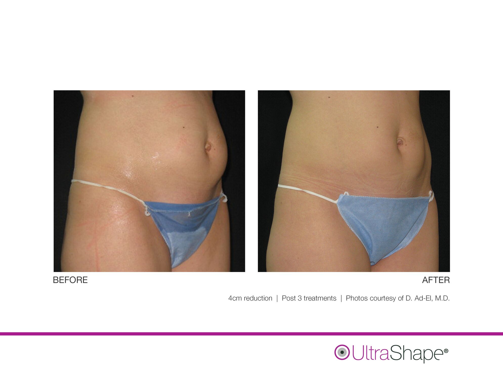 UltraShape_B_and_A_image-6_sidebyside_0.jpeg