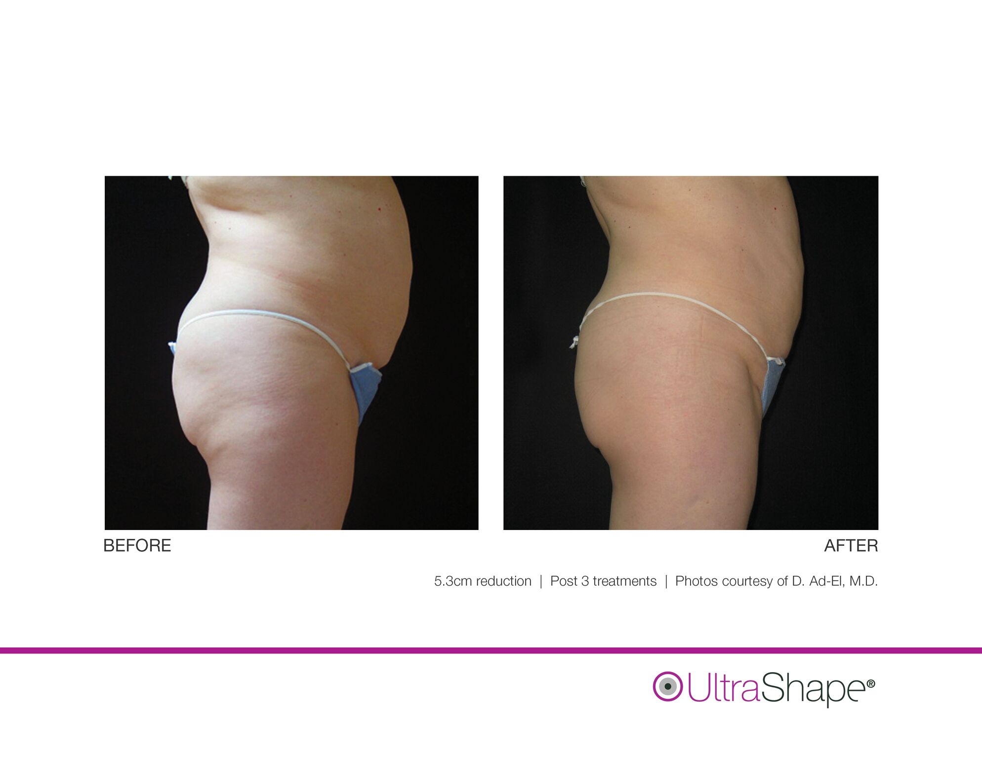 UltraShape_B_and_A_image-7_sidebyside.jpeg