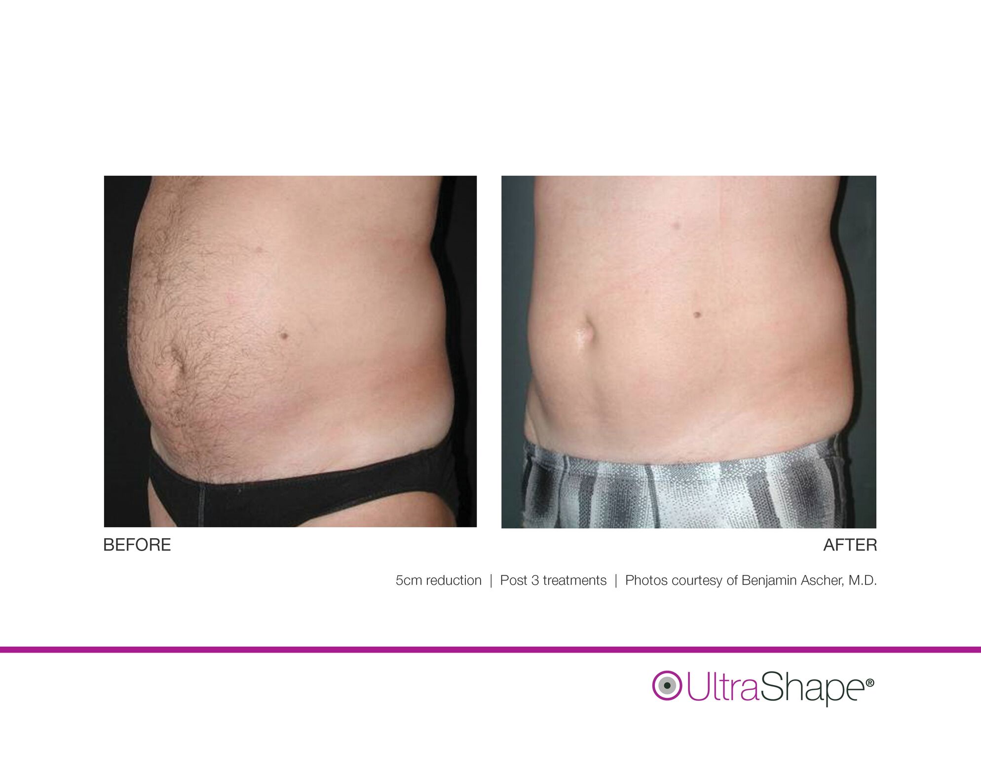 UltraShape_B_and_A_image-8_sidebyside.jpeg