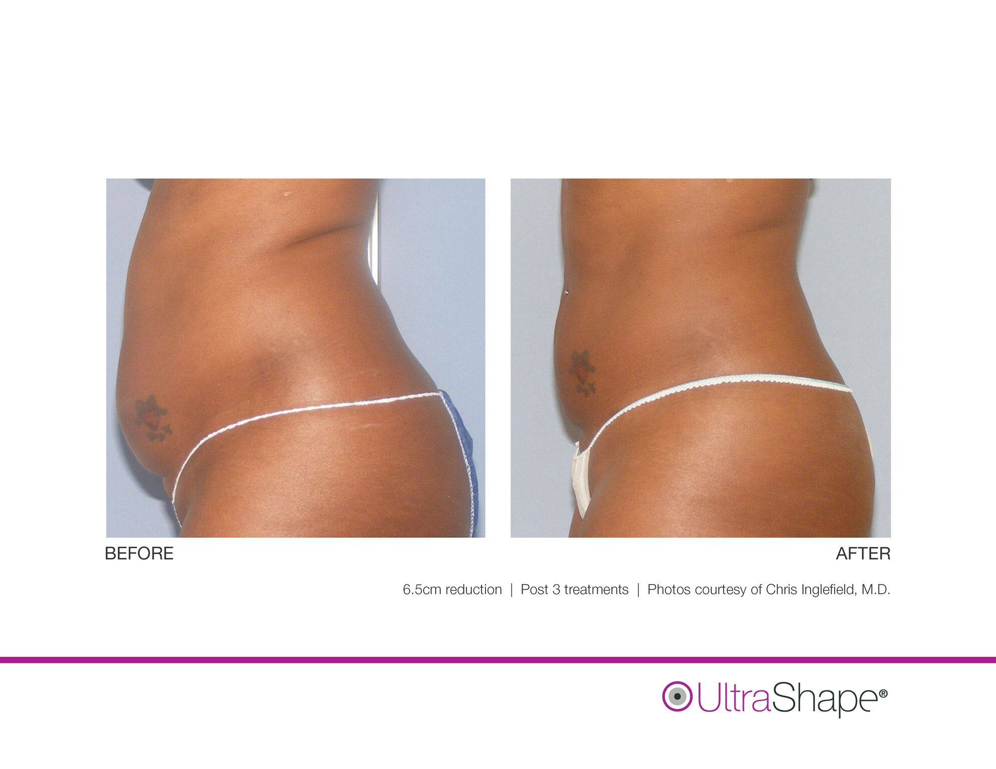 UltraShape_B_and_A_image-10_sidebyside.jpeg