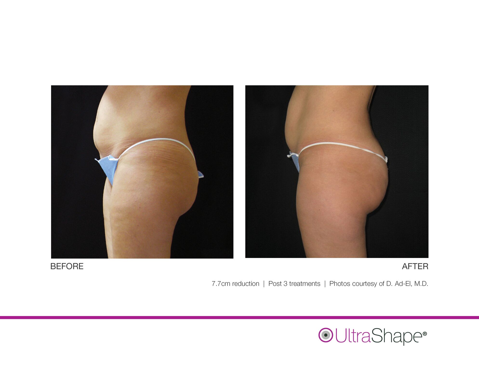 UltraShape_B_and_A_image-12_sidebyside.jpeg