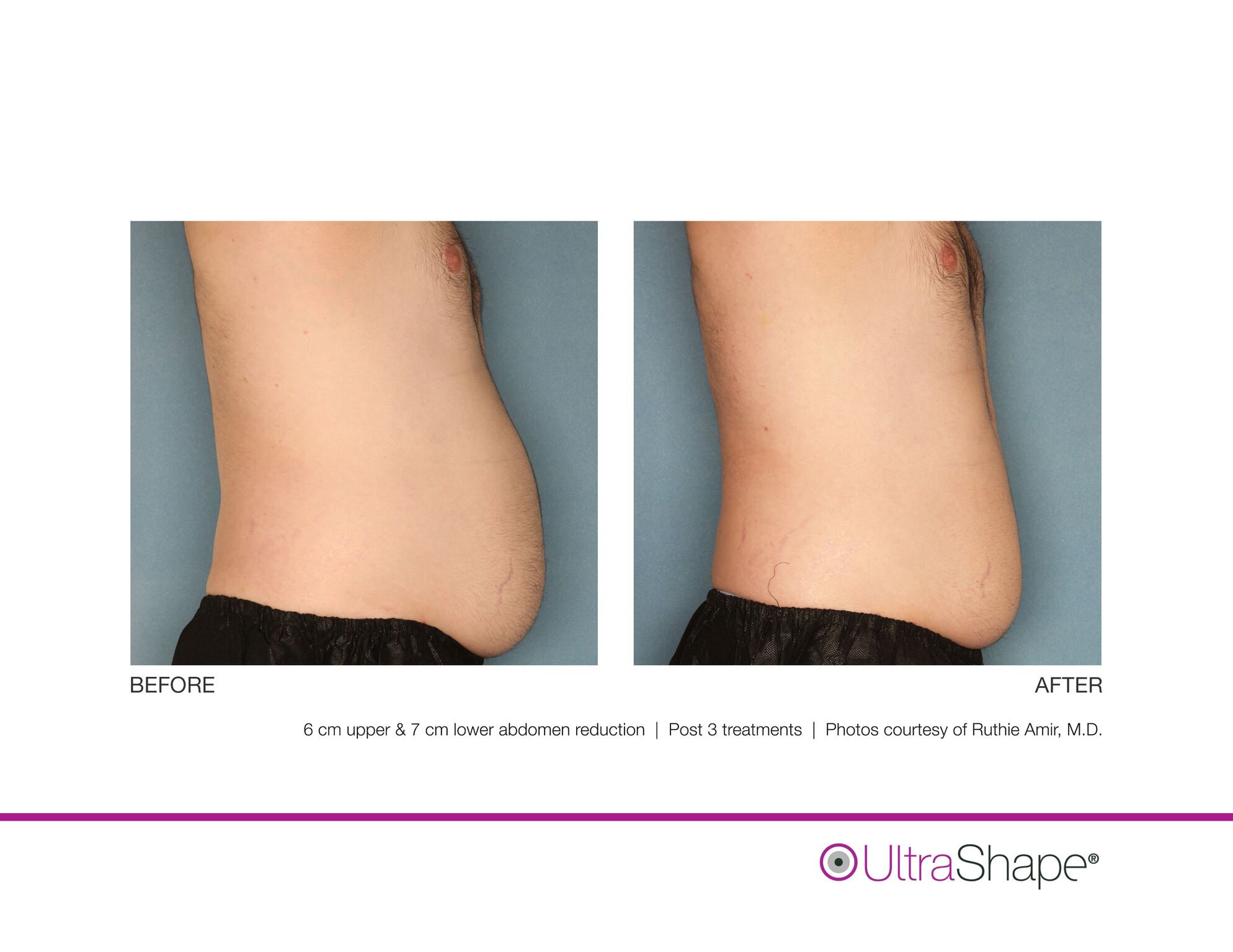 UltraShape_B_and_A_image-15_sidebyside.jpeg