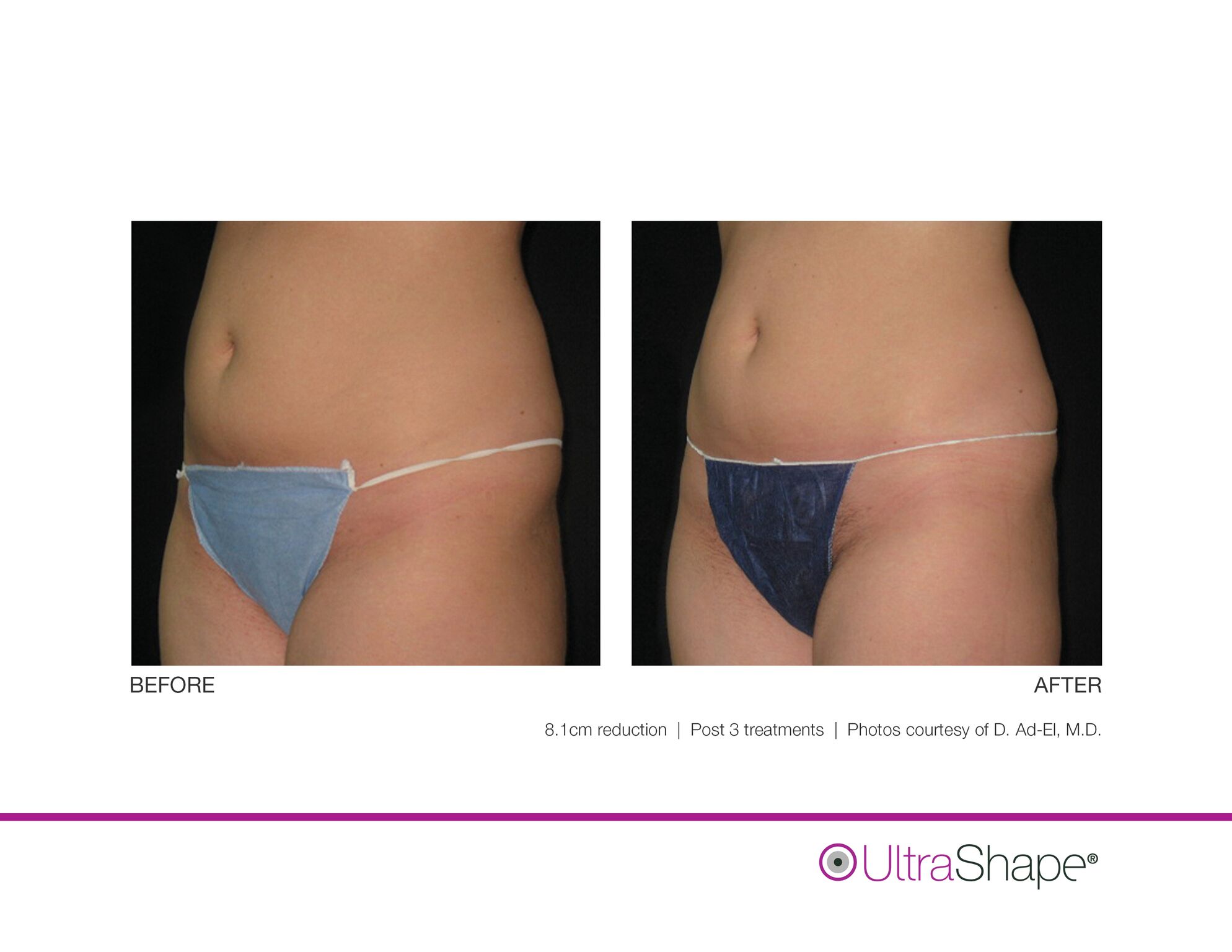 UltraShape_B_and_A_image-16_sidebyside_0.jpeg