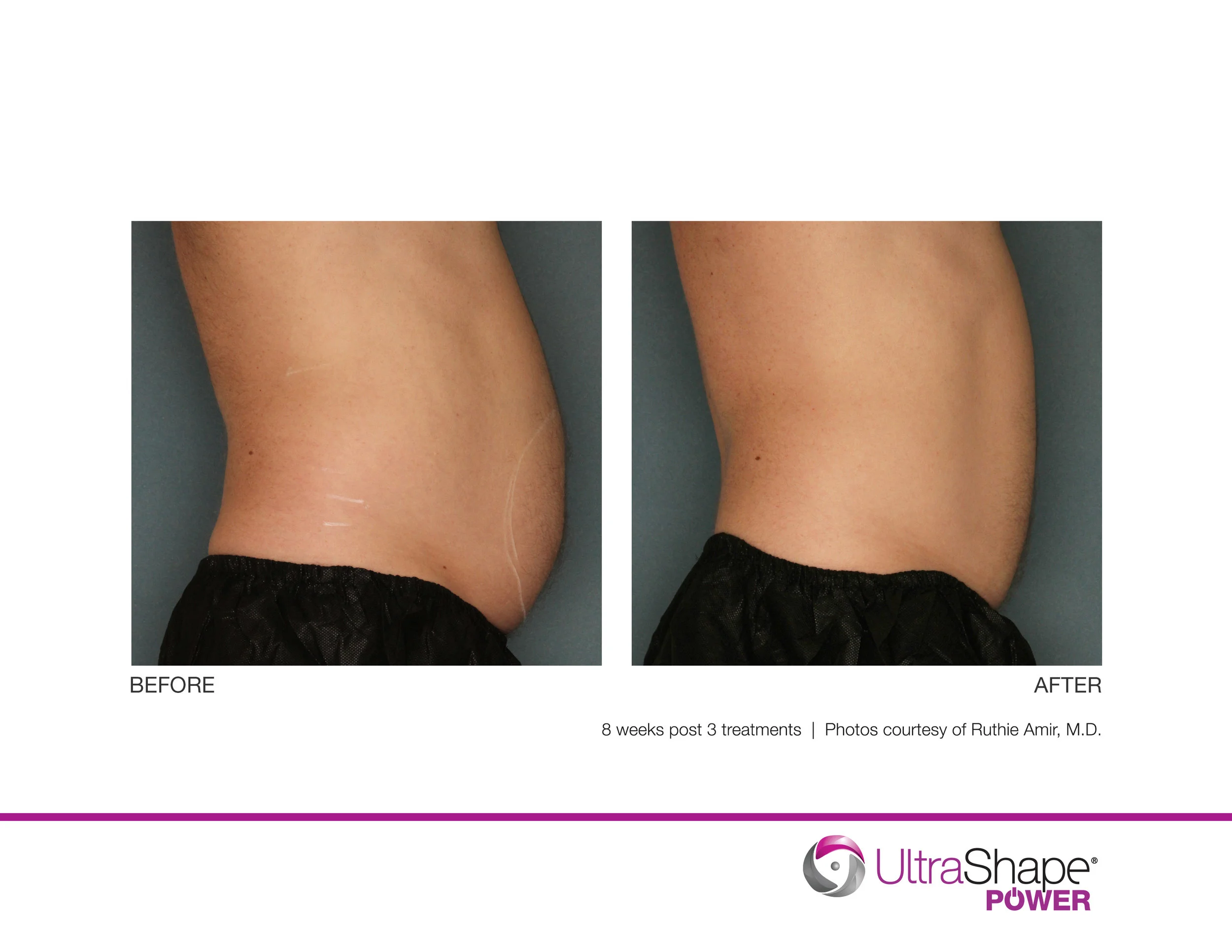 UltraShape-Power-8w-post-3tx-RAmir-MD_highres.jpg