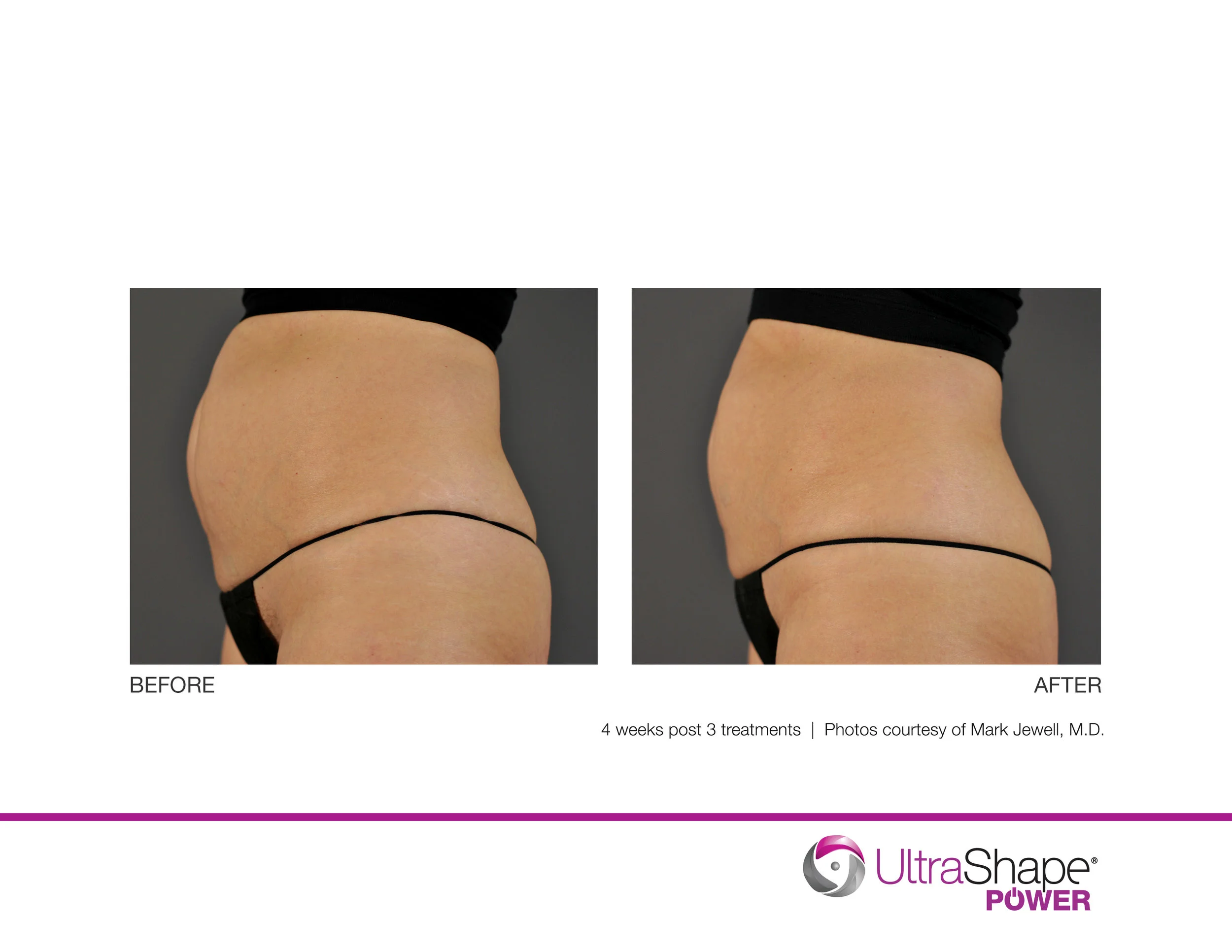 UltraShape-Power-P2-4w-post-3tx-MJewell-MD_highres.jpg