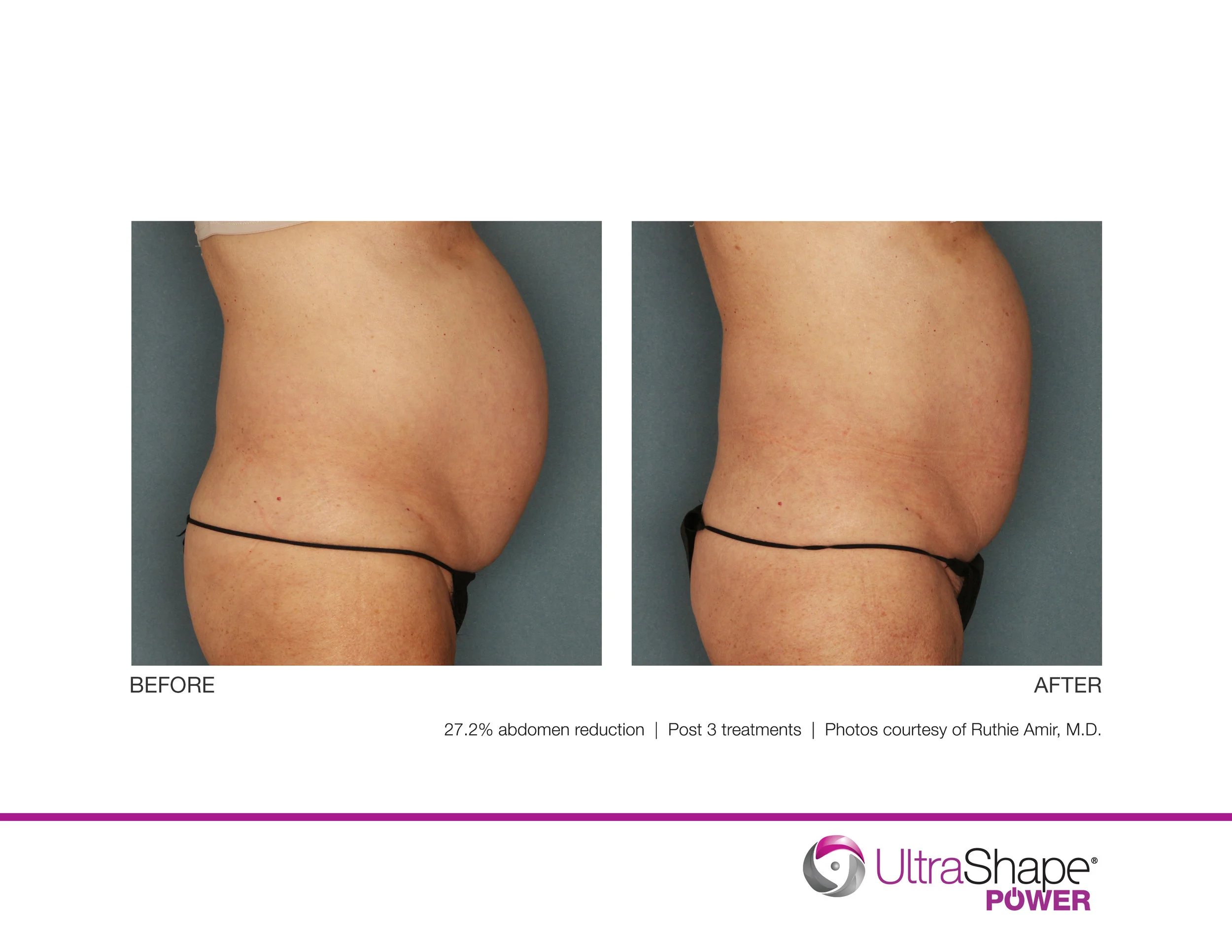 UltraShape-Power-27percent-reduction-RAmir-MD_highres.jpg