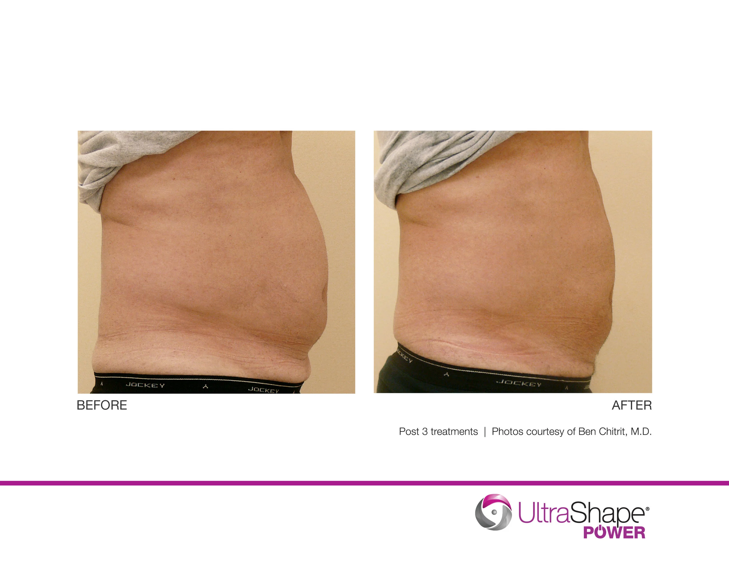 UltraShape-Power-post3tx-BChitrit-MD_highres.jpg