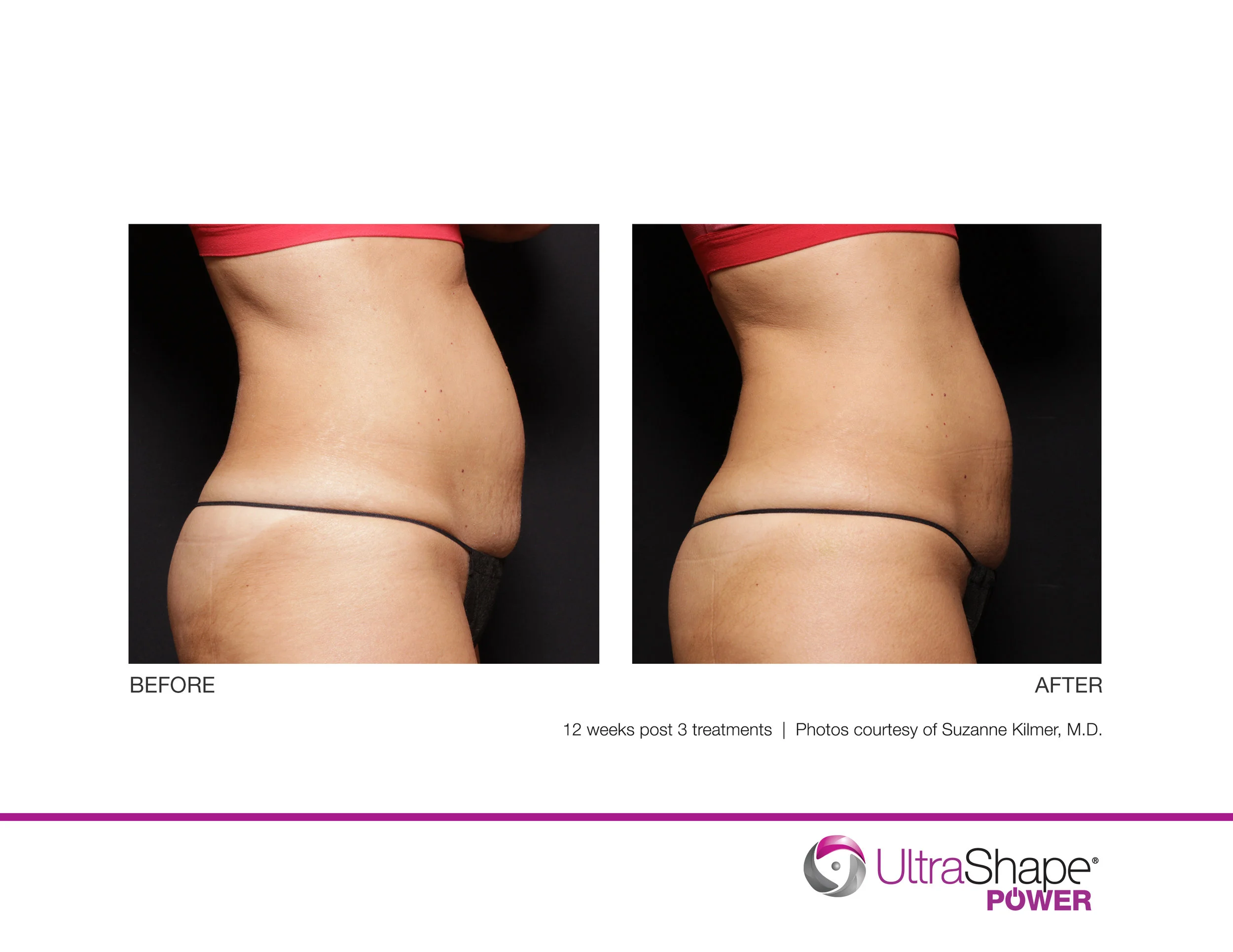 UltraShape-Power-P4-12w-post-3tx-SKilmer-MD_highres.jpg