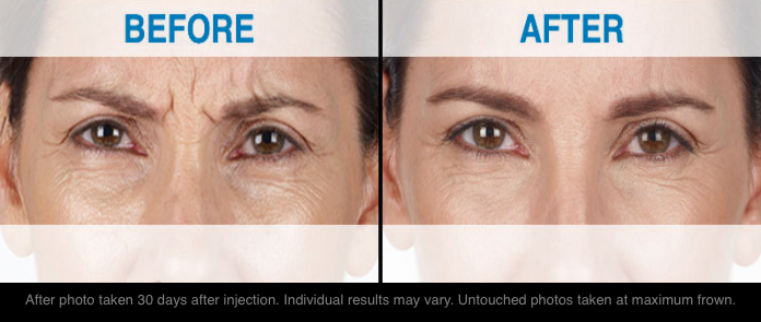 Photo courtesy of Merz Aesthetics . 