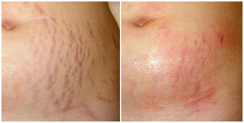Microneedling Lux Co