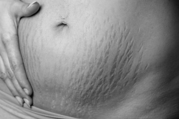 Mother, mom, stretch marks, self-esteem, acceptance