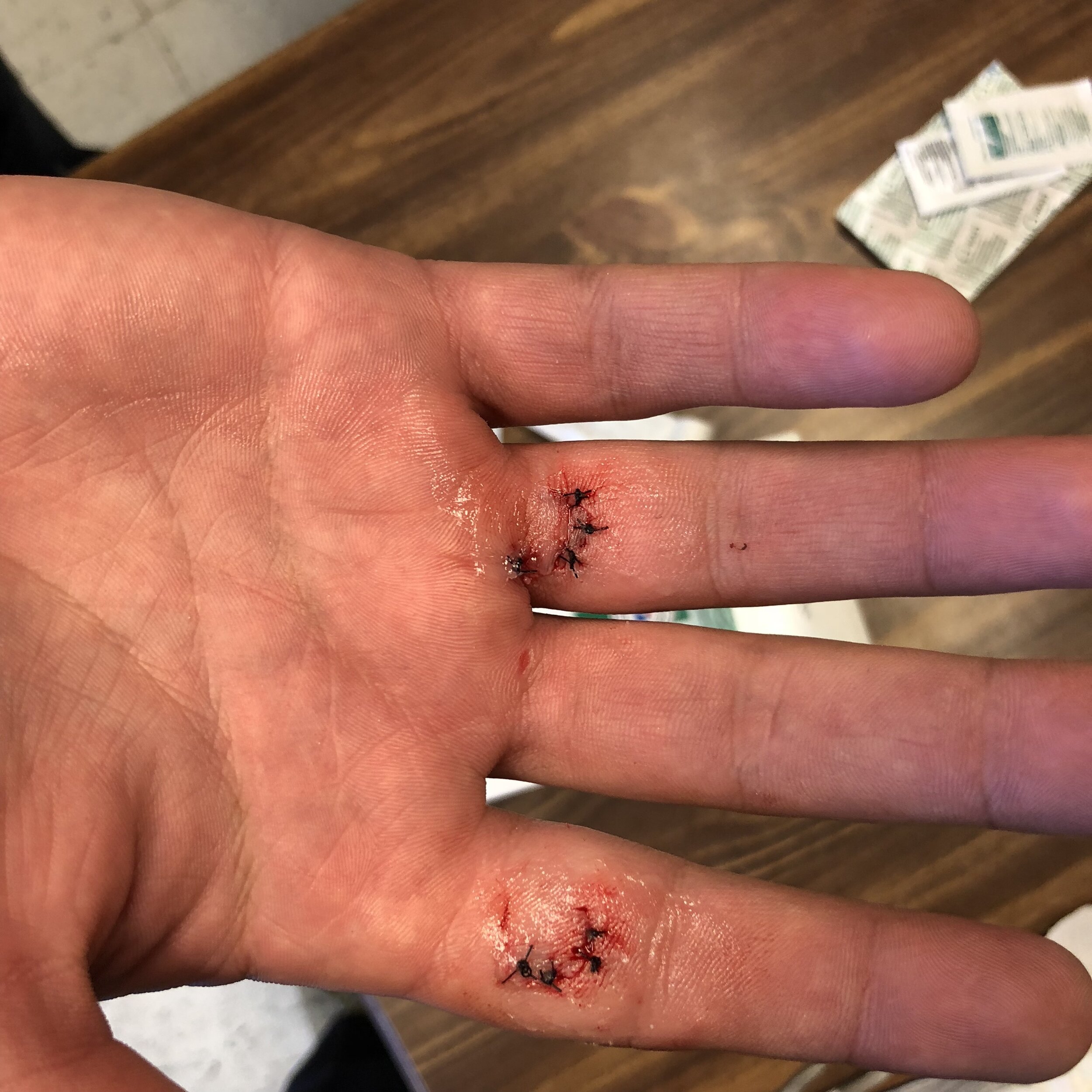 Our patient cut his hand aka had a laceration, and we were able to sew up the cut (suture the wound) about 20 minutes after the incident happened. This can ensure that healing is optimal and scar tissue is minimal.