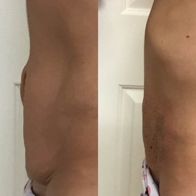 Stretch Marks & “Mummy Tummy”