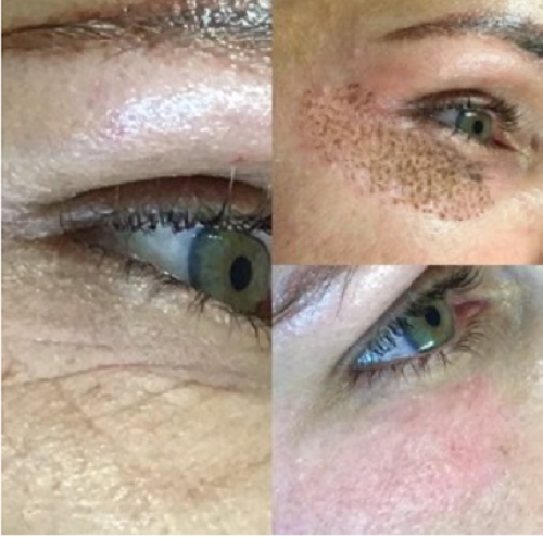 Before, Immediately After, and 6 Days later. Skin continues to heal and tighten for 5 weeks.