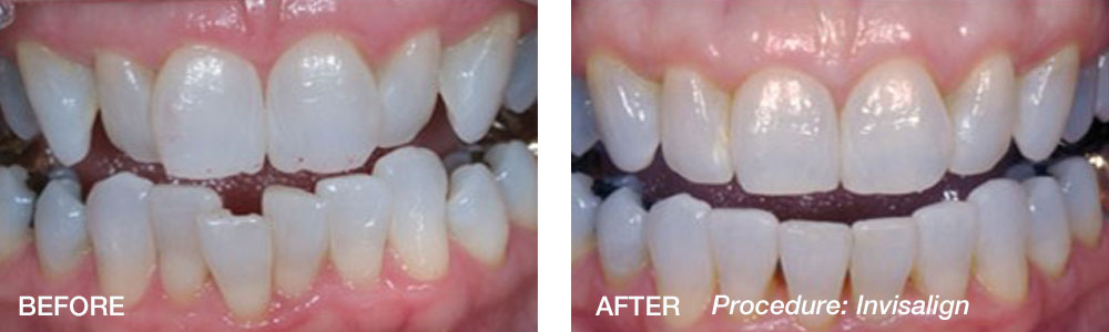 Invisalign-Before-After-Weiss.jpg