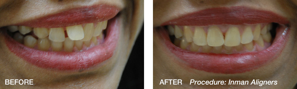 Inman-Aligners-Before-After-2-Weiss.jpg
