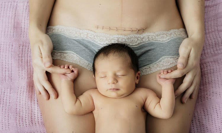 Cesarean is Strength