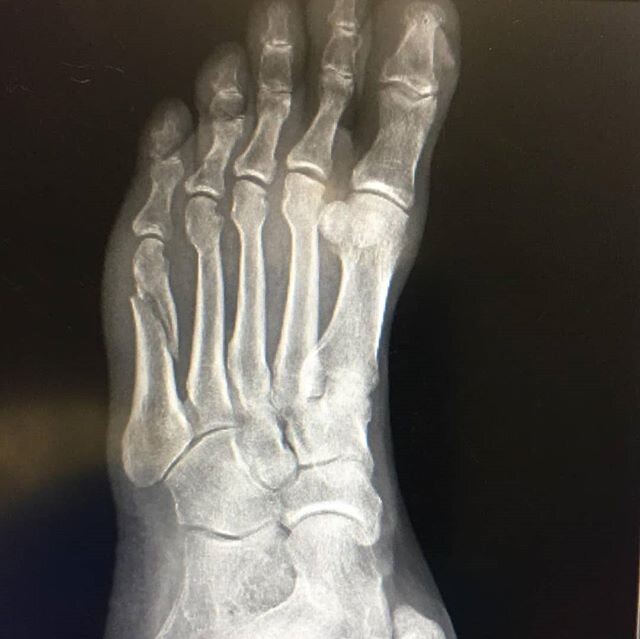 The perils of farm work. My poor farming partner and hubby broke a bone in his foot today! Had to wait in the car outside the (empty) ER during the x-ray.